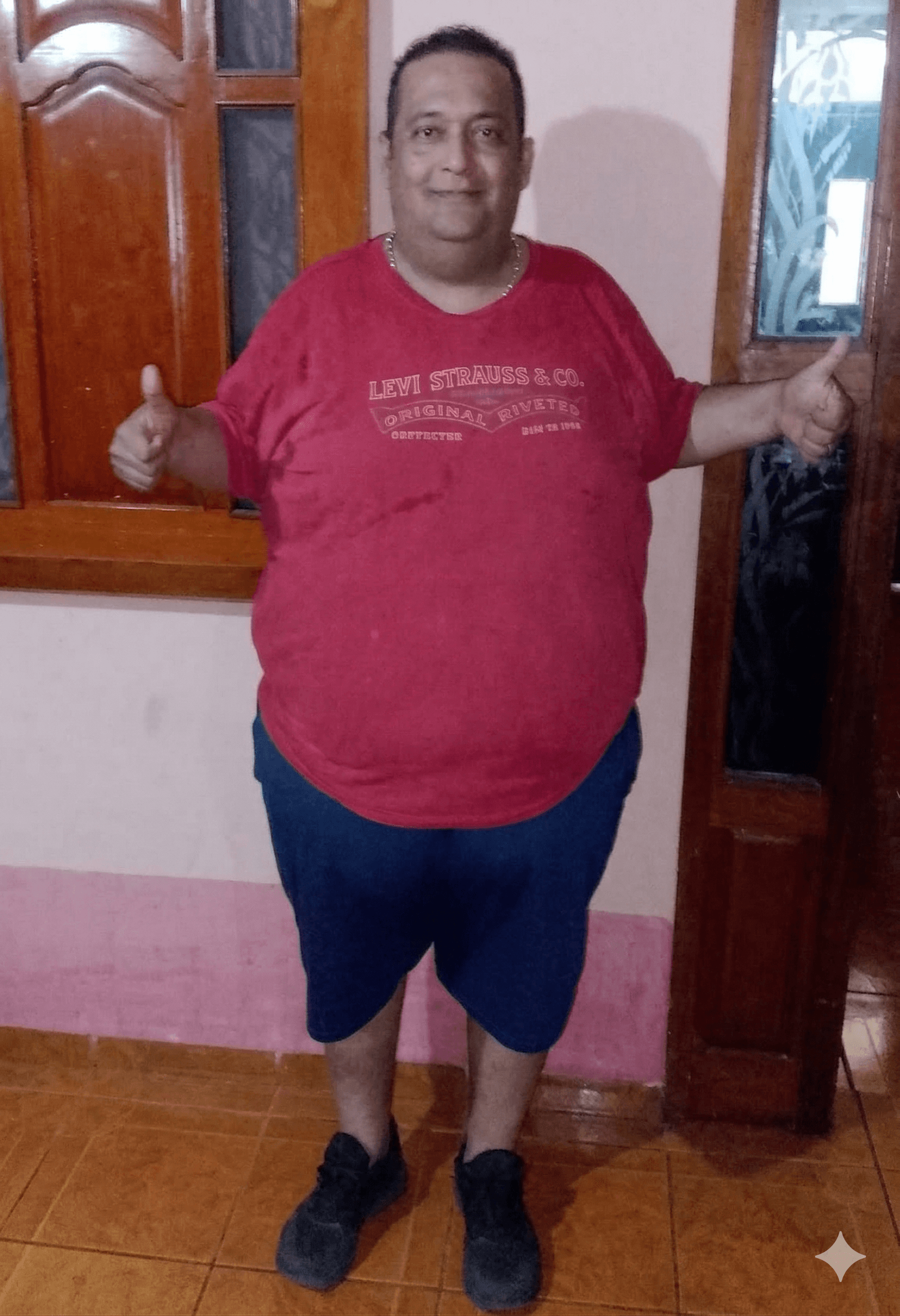 Resultado después de la cirugía bariátrica