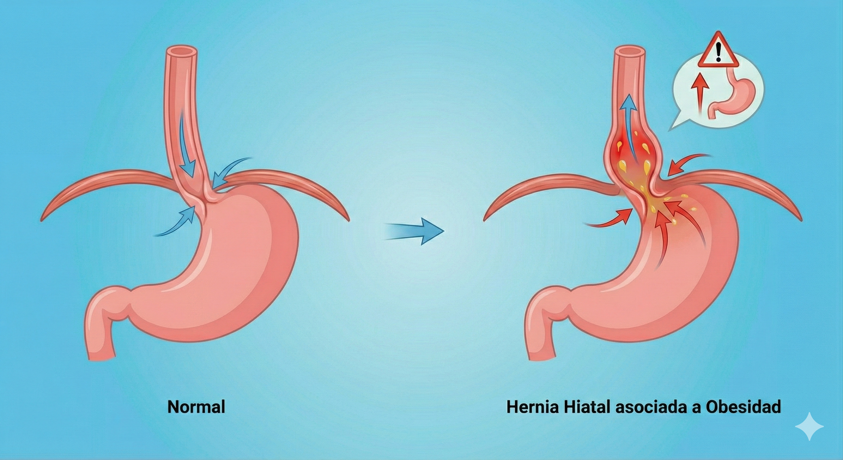 HERNIA HIATAL ASOCIADA A LA OBESIDAD