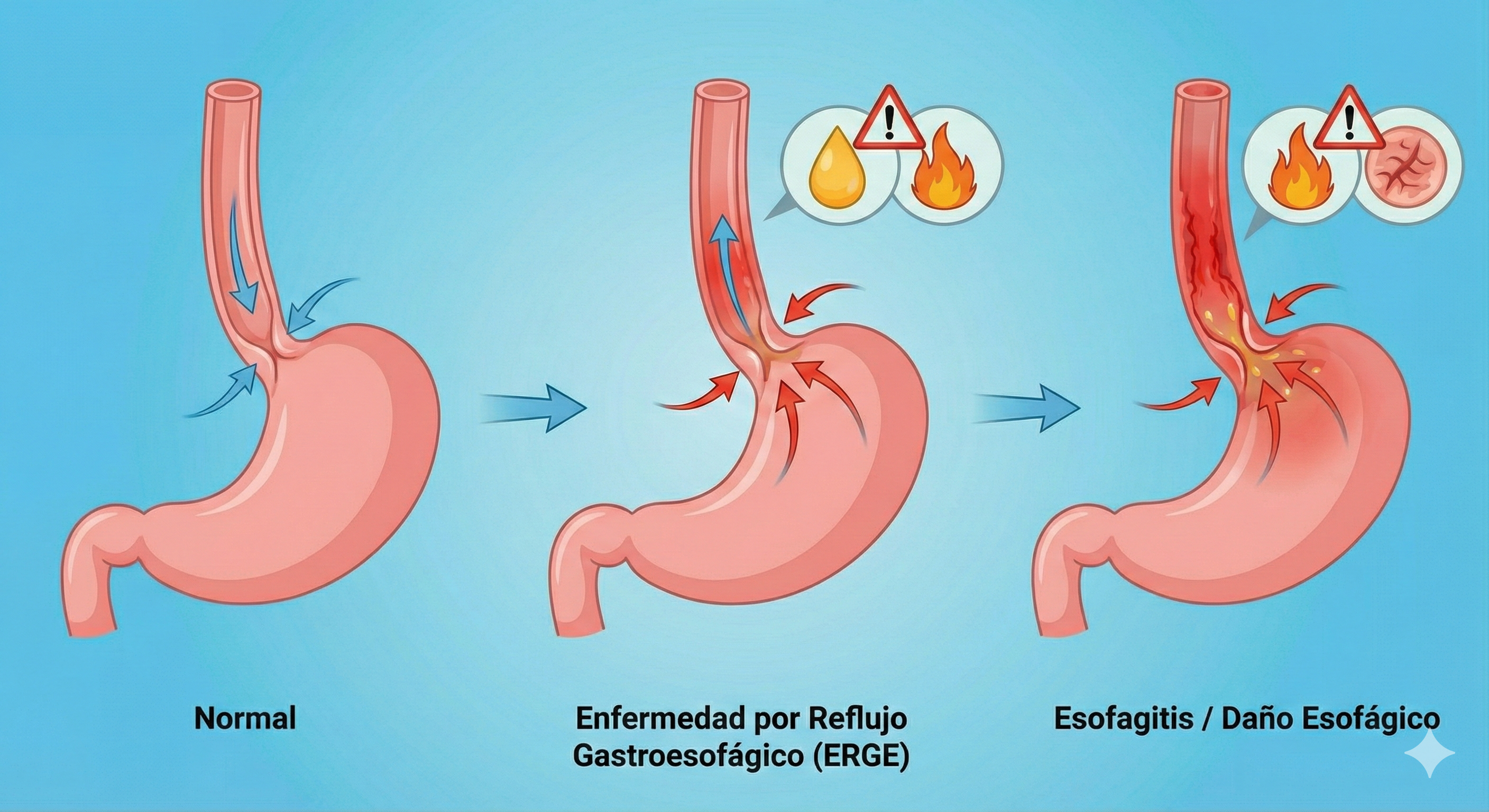 ENFERMEDAD POR REFLUJO GASTROESOFÁGICO ASOCIADA A LA OBESIDAD